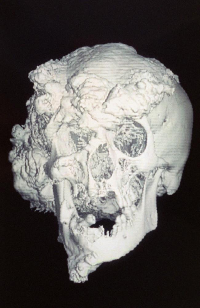 The skull of Joseph Merrick. Picture: Alamy