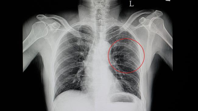 File photo of an x-ray showing a broken rib.