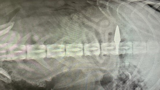 An X-ray image of Bucket’s spinal injury after being shot by a bow and arrow.