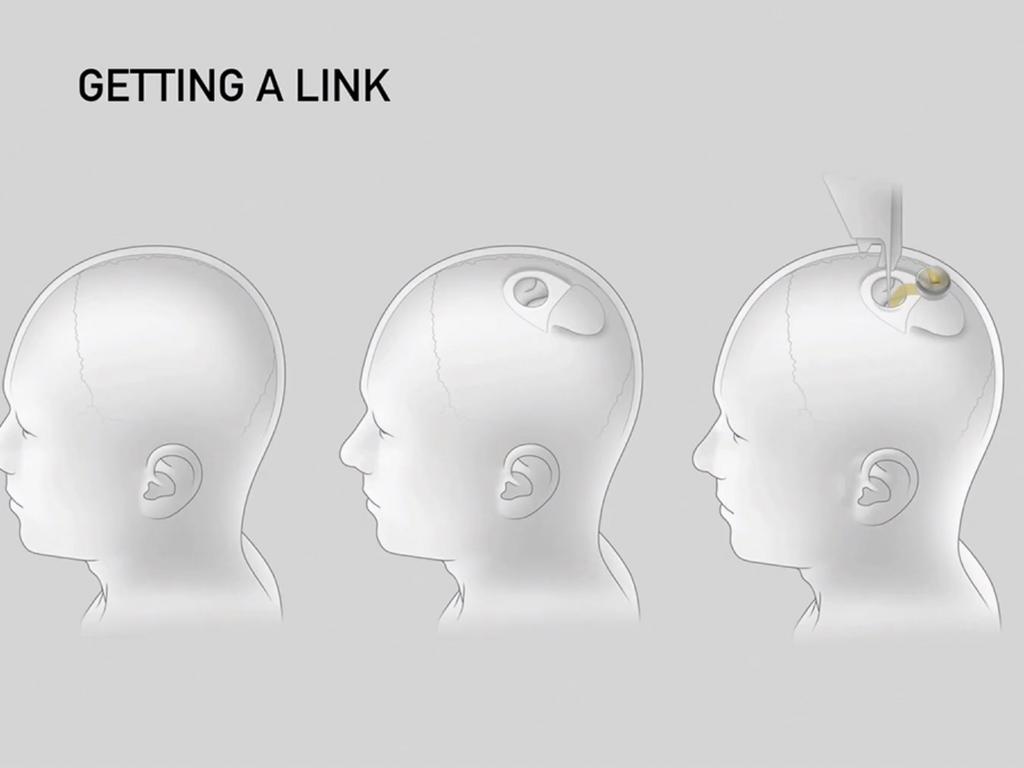 A drawing of the different steps of the implantation of a Neuralink device. Picture: Neuralink/AFP