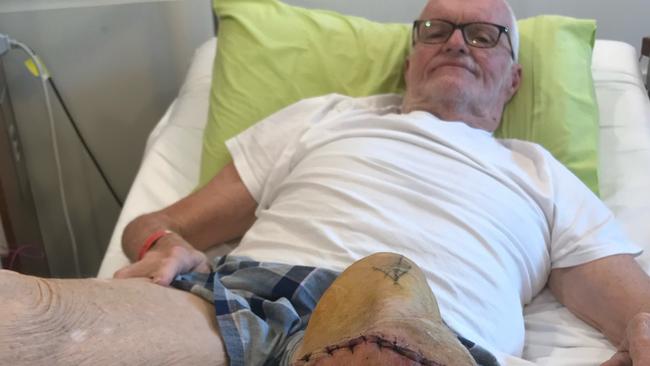 Barry Porter, of Mackay, had to have his leg amputated after a blister became infected. Picture: Contributed