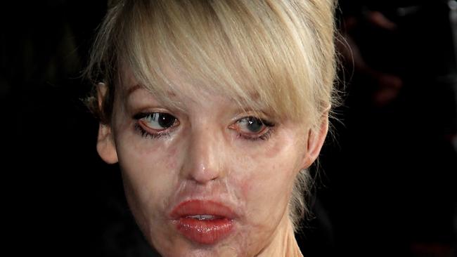 Acid Attack Survivor Katie Piper Is Pregnant Daily Telegraph 