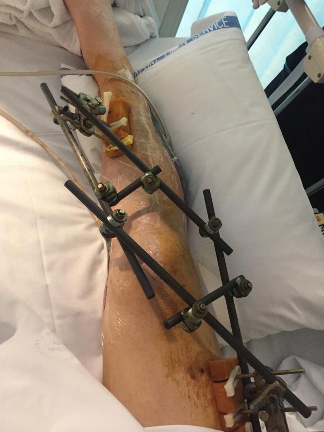Big wave surfer Mark Mathews’s injured leg after surgery.