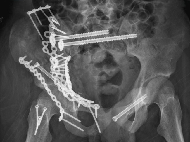 Zach Holden pelvis scan with screws from February 2022.