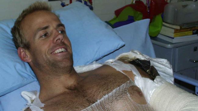 Julian Burton after he was horribly injured and burned in the 2002 Bali bombings. Picture: supplied