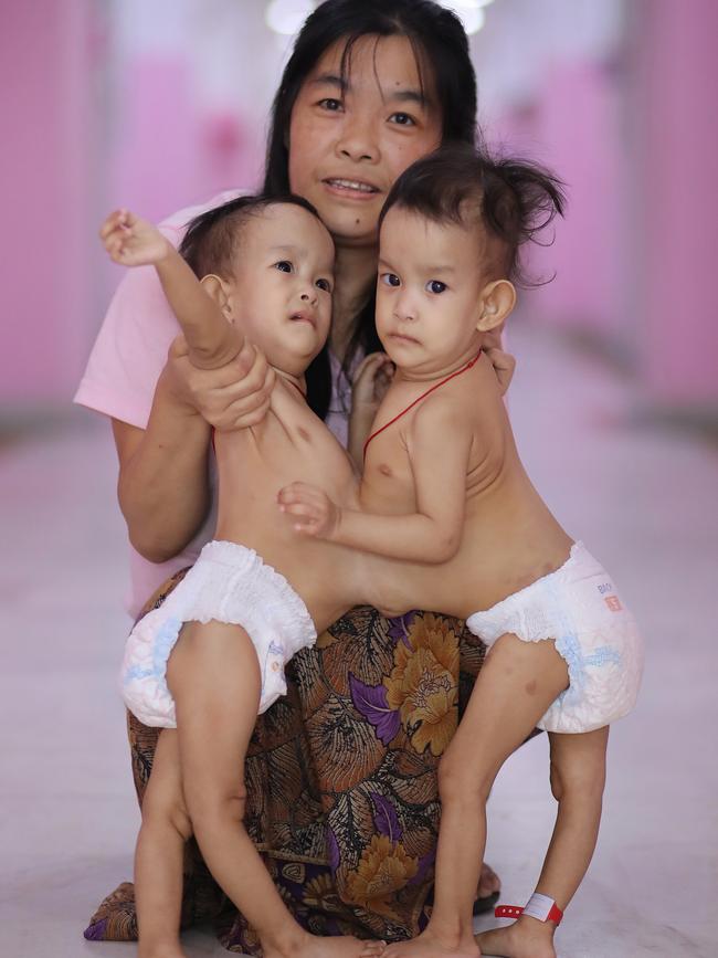 Nima and Dawa before their surgery. Picture: Alex Coppel