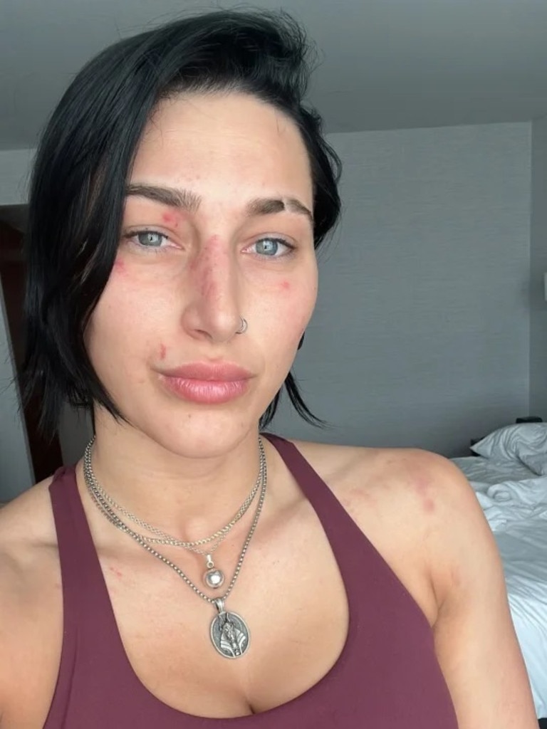 Rhea Ripley shows some war wounds. Photo: Twitter, @rhearipley_wwe.