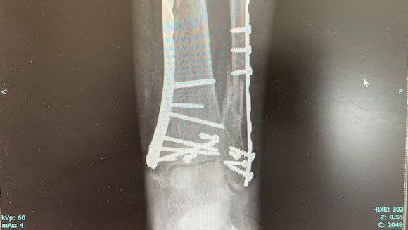 Scans showing pins and metal in Kerry Deague's leg. Picture: Supplied