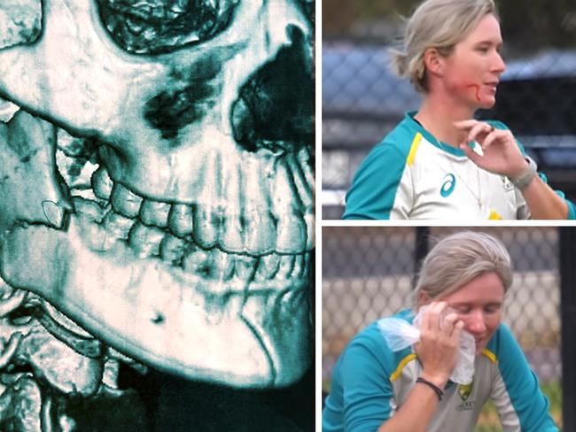 Beth Mooney's remarkable toughness to battle on after breaking her jaw.