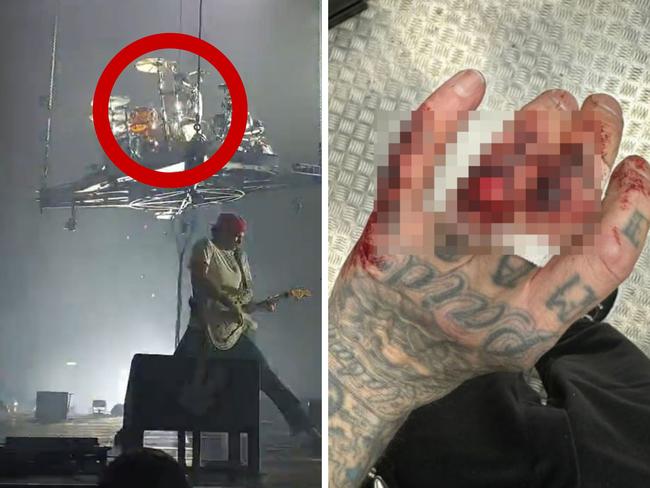 Travis Barker sustained a gruesome hand injurt onstage during Blink-182's concert in Manchester, UK.