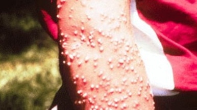 Pustules resulting from fire ant stings. Picture: Murray S. Blum, The University of Georgia.