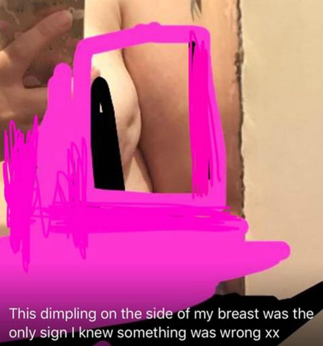 dimpling on breast image