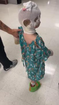 Burnt little boy walks again after home fire 