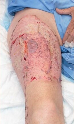 The Perth man was left with third-degree burns. Picture: 9 News