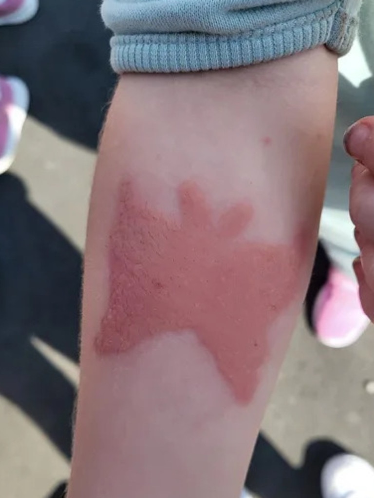 She went home with a painful, bleeding burn. Picture: Facebook.