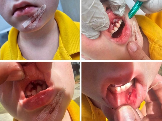 Queensland mother slams school after son’s horror playground injury