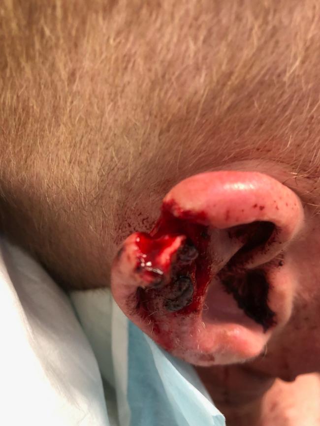 **WARNING GRAPHIC CONTENT**Police will allege Mr Millington bit an off-duty police officer’s ear during an incident at the Richmond Hotel on Keen St, Lismore on December 13, 2019. Supplied