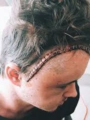 Johnny Ruffo after having emergency surgery to remove his brain tumour in 2017.