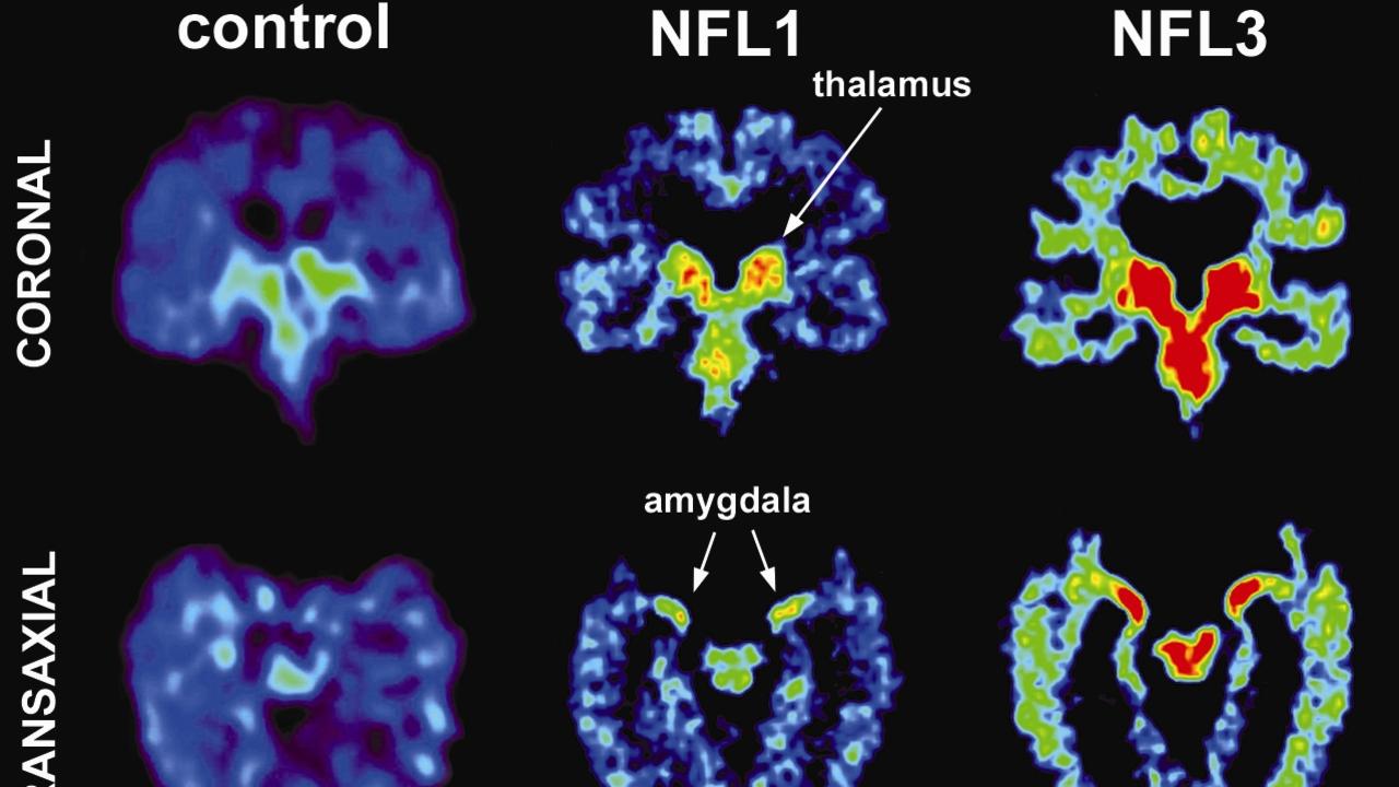 what-is-cte-how-chronic-traumatic-encephalopathy-affects-people