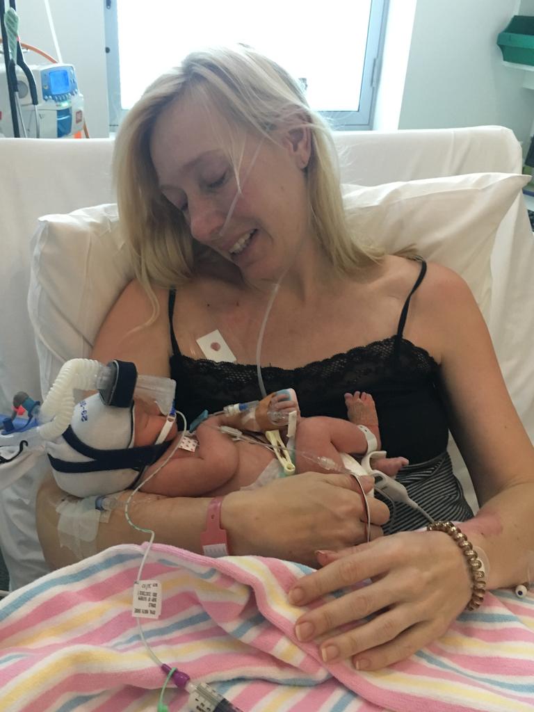 Little Tilly was born eight weeks premature because Mrs Donald had sepsis.