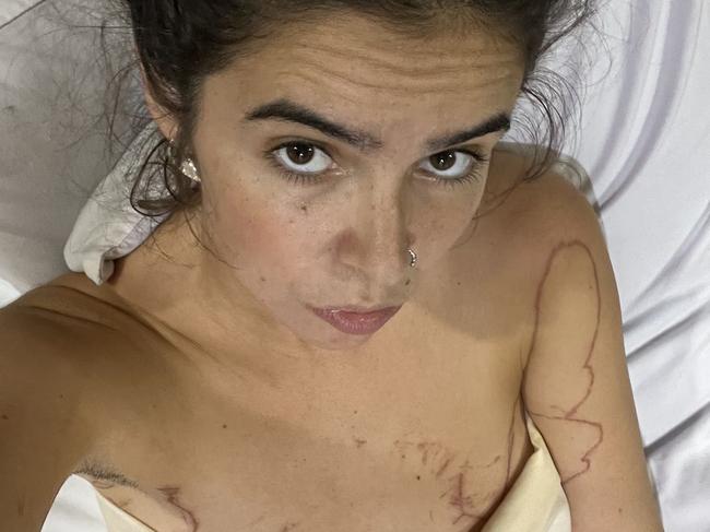 Australian woman Zoe Cahill shows the scars from a jellyfish attack.