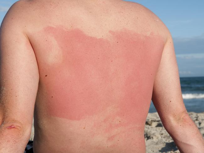 Almost 300 Victorians suffered sunburn so severe they had to go to the emergency department last financial year. Picture: Supplied