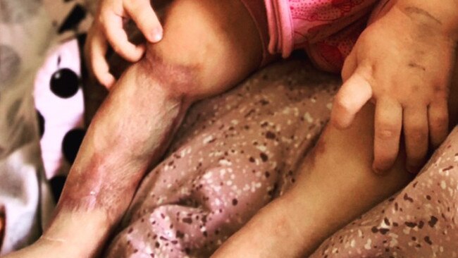 Lilliana Sheridan has undergone 55 surgeries to remove the damaged tissue from her infected legs.