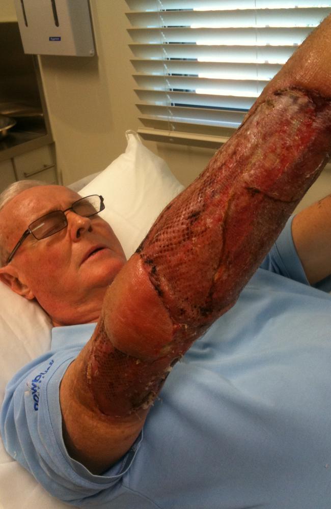 Mr Hewitt, 80, of Sorrento, shows the devastating impact of the Buruli or Bairnsdale Ulcer.