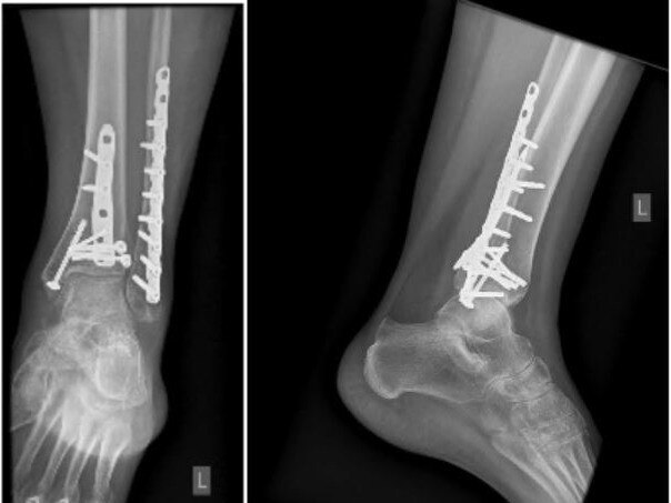 X-rays of Hamlyn Heights woman's foot injury