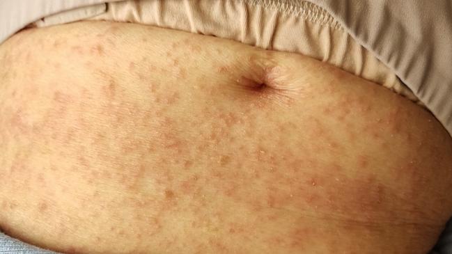 An image showing a rash on Heather Adey’s abdomen. Picture: Supplied