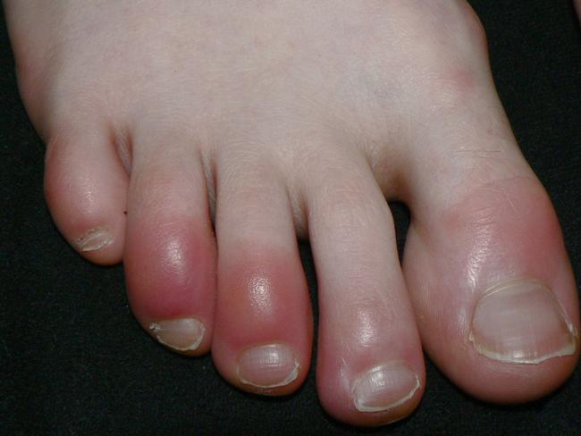 A person with chilblained toes. Picture: Wikipedia