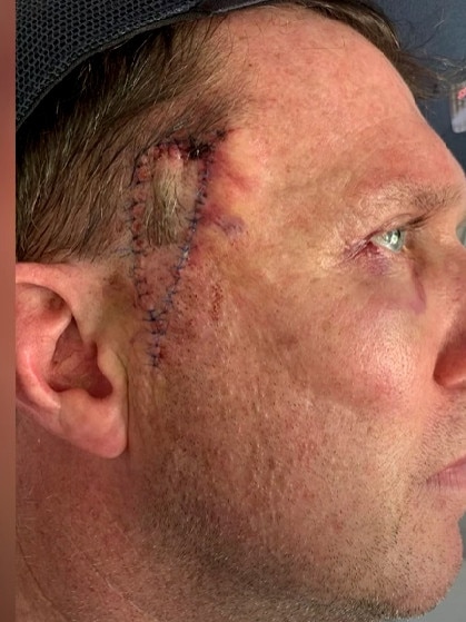 Image of Nine newsreader Peter Overton undergoing surgery for melanoma removal in 2021, Picture: Nine News 2021