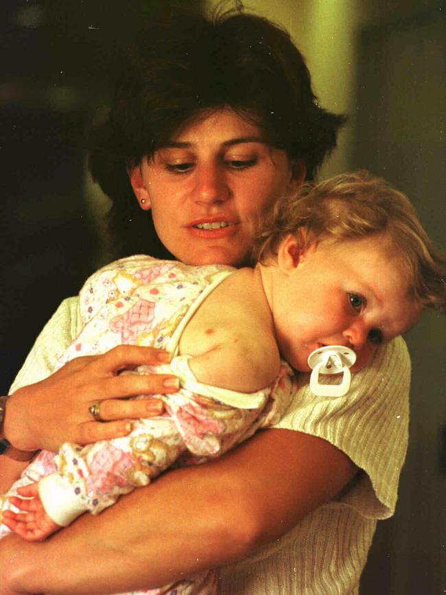 Sharyn Rowles shows teeth marks on her daughter Kasey's back.