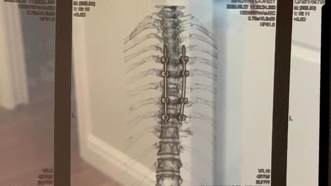 Corey Brown fractured his T7 vertebra in a fall last year.