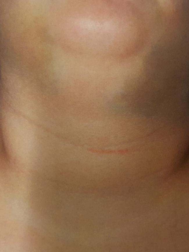 These neck injuries came after the victim was choked by a dog lead. Picture: SA Police