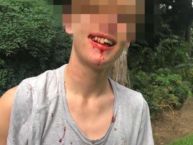 An image of a bloodied student from another school, after being involved in a fight with a student from Brisbane State High School.