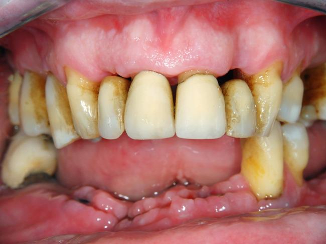 Heavy calculus deposits, gum swelling, chronic inflammation, gingival recession, missing teeth and stains. This could be you.