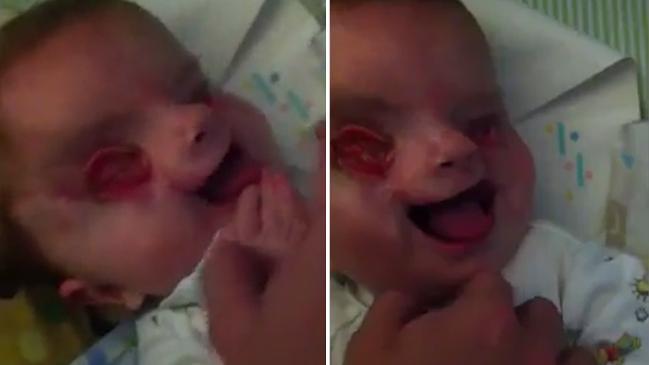baby born without eyes
