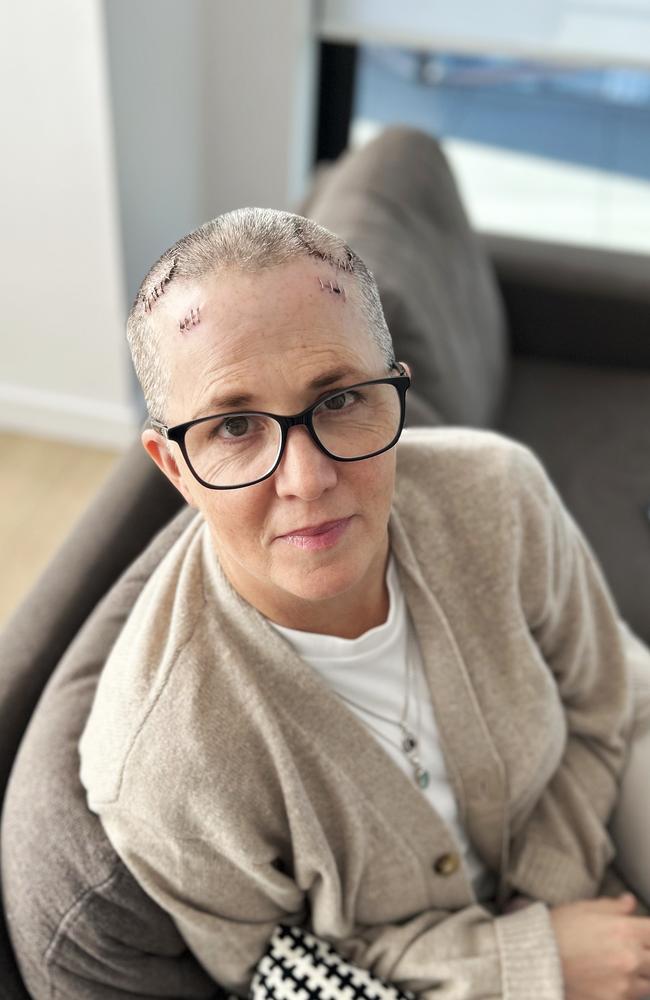 Author Jo Dixon recovering from brain surgery for parkinsons disease. Picture: supplied