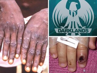 Monkeypox cases linked to adult sauna, fetish festival