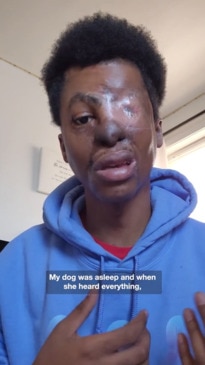 Pitbull attack leaves boy with 20% of his face
