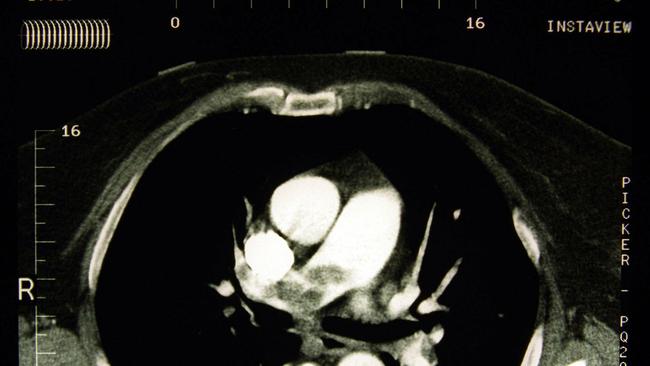 An X-ray showing the pulmonary artery with large load embolic clot. Picture: Matthew White