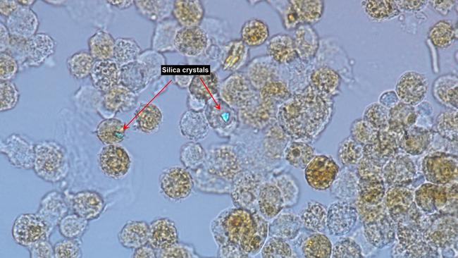 Cells taken from the lungs of a patient with silicosis, notice the speck of silica dust shining brightly