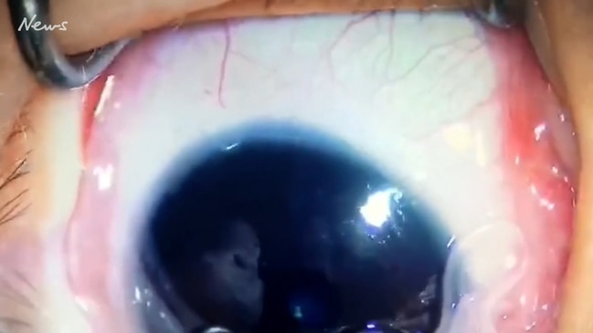 11 worms plucked from infant's eye