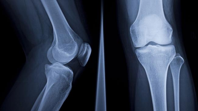 X-Ray of human knee  Picture: istock