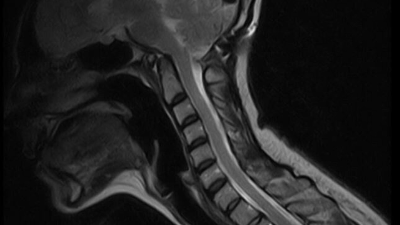 Rachel underwent occipital spinal fusion surgery to relieve the compression from her brain stem. Source: GoFundMe