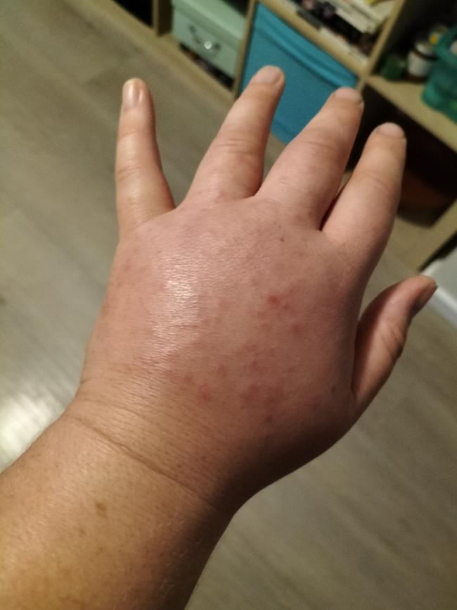 Natasha Van Eck's swollen hand from cellulitis. Picture: Supplied