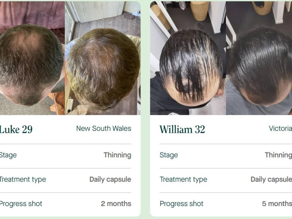 In Mosh testimonials, before and after pictures of men experiencing male-pattern baldness have seen significant improvement with consistent treatment. Picture: Mosh website