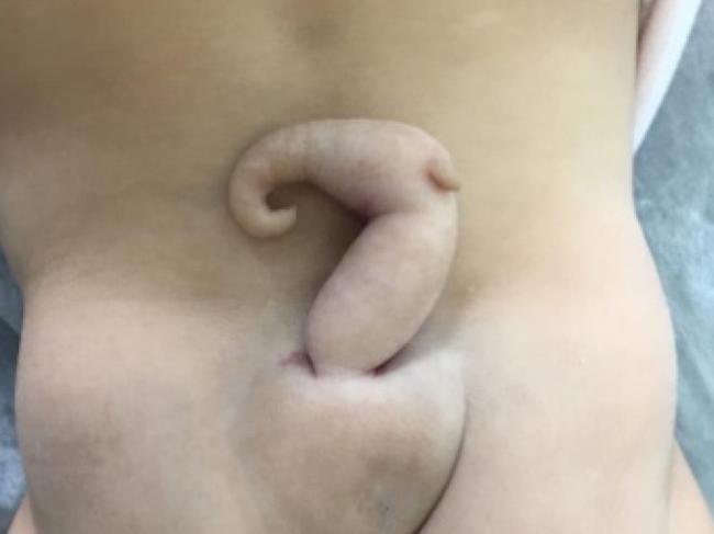 A baby girl in Brazil was born with a tail. Picture: Journal of Pediatric Surgery Case Reports