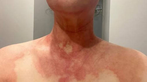 Michelle Kate described her symptoms as coughing, rashes, hives, burning skin, eye irritation and skin dryness from the Ipswich stench. Picture: Supplied